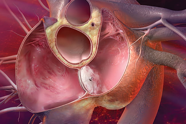 Healing a hole in the heart