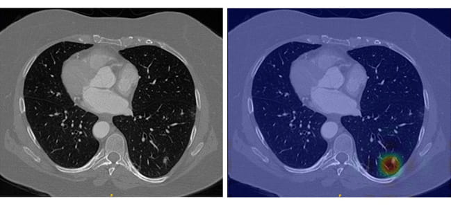 Lung nodules in an unaltered CT scan require sharp eyes for detection (left), but LungWeb highlights suspicious areas to make detection much less labor intensive (right).