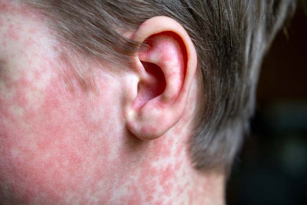 Person's ear with red spots on it