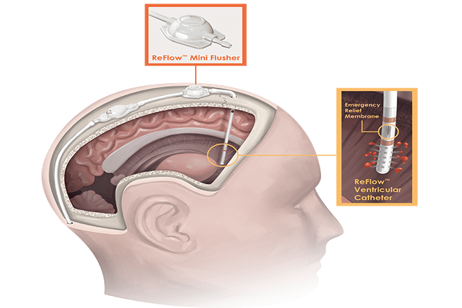 Illustration of mini ReFlow device on simulated human skull with cutaway to show the location of the pump and membrane
